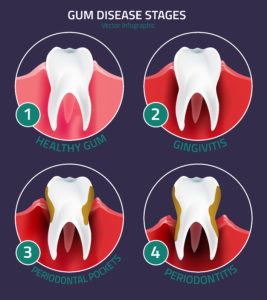 Gum Disease - Greenville, TX dentist