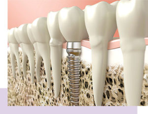  Dental Implants - Greenville dentist